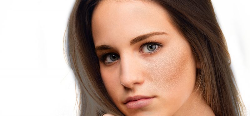 What are the Reasons for Pigmentation On Face