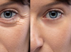 Woman eyes before and after an anti age treatment for wrinkles and crow's feet